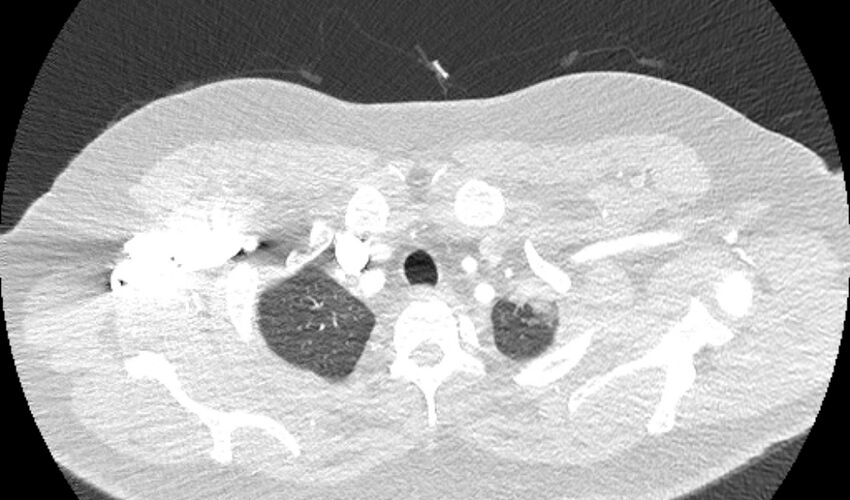 Acute pulmonary embolism with pulmonary infarcts (Radiopaedia 77688-89908 Axial lung window 1).jpg