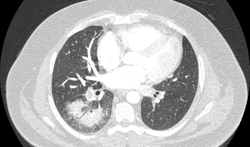 Acute pulmonary embolism with pulmonary infarcts (Radiopaedia 77688-89908 Axial lung window 69).jpg
