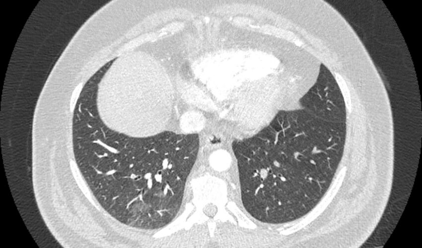 Acute pulmonary embolism with pulmonary infarcts (Radiopaedia 77688-89908 Axial lung window 95).jpg