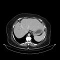 Acute pyelonephritis (Radiopaedia 25657-25837 Axial renal parenchymal phase 16).jpg
