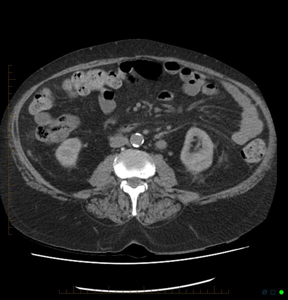 File:Acute renal failure post IV contrast injection- CT findings (Radiopaedia 47815-52557 Axial non-contrast 42).jpg
