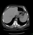 Acute renal failure post IV contrast injection- CT findings (Radiopaedia 47815-52559 Axial C+ portal venous phase 13).jpg