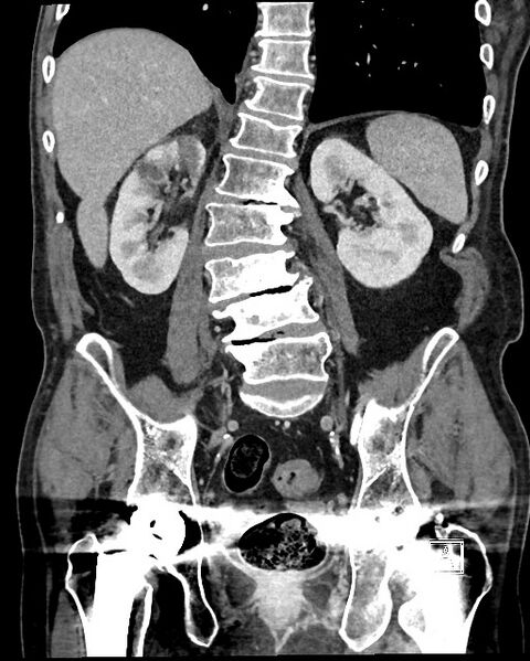 File:Acute renal infarction - rim capsular enhancement (Radiopaedia 59833-67270 Coronal C+ portal venous phase 39).jpg