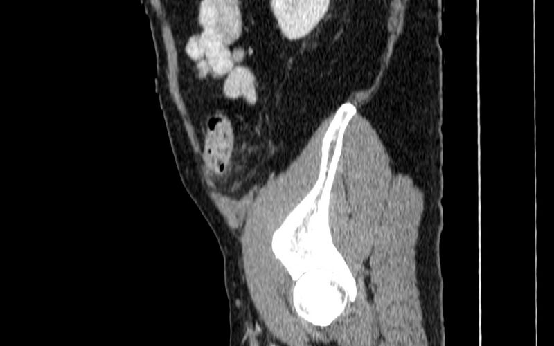 File:Acute sigmoid colon diverticulitis (Radiopaedia 55507-61976 Sagittal C+ portal venous phase 109).jpg