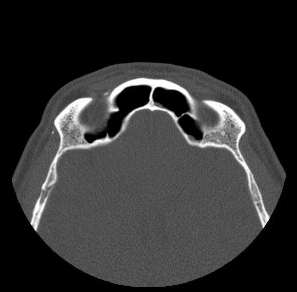 File:Acute sinusitis (Radiopaedia 23161-23215 Axial bone window 64).jpg