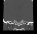 Acute sinusitis (Radiopaedia 23161-23215 Coronal bone window 60).jpg
