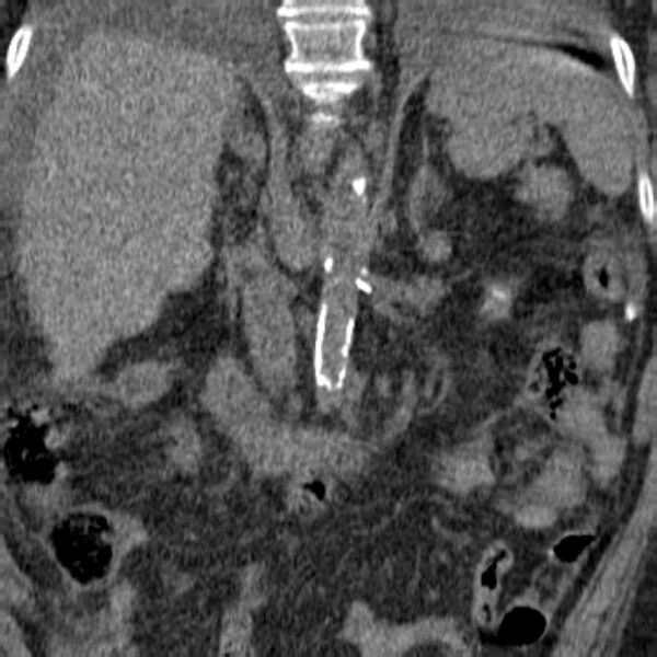 File:Acute tubular necrosis (Radiopaedia 28077-28334 Coronal non-contrast 3).jpg