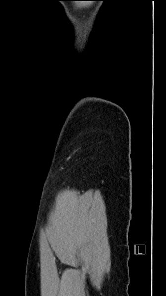 File:Acute uncomplicated appendicitis (Radiopaedia 61374-69304 Sagittal C+ portal venous phase 101).jpg