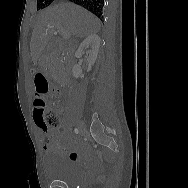 File:Acute vertebral body compression fractures (Radiopaedia 31757-32693 Sagittal bone window 48).jpg