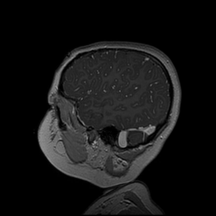 Adamantinomatous craniopharyngioma (Radiopaedia 77407-89529 H 22).jpg
