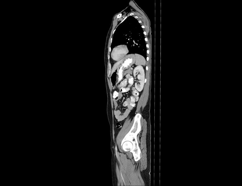 File:Addison disease (Radiopaedia 49318-54412 Sagittal C+ portal venous phase 19).jpg