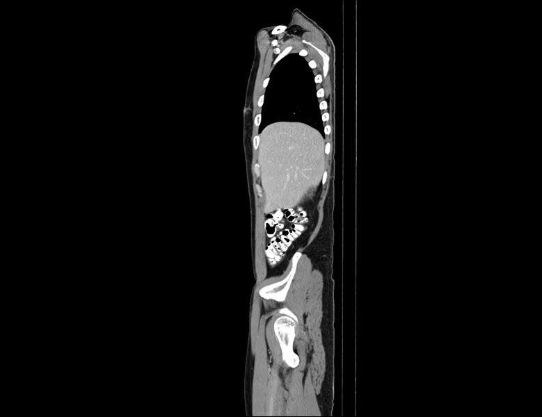 File:Addison disease (Radiopaedia 49318-54412 Sagittal C+ portal venous phase 58).jpg