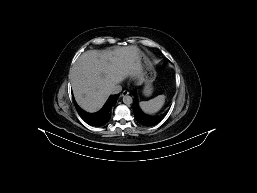 Adenocarcinoma of pancreas with hepatic metastasis (Radiopaedia 64332-73122 Axial non-contrast 18).jpg