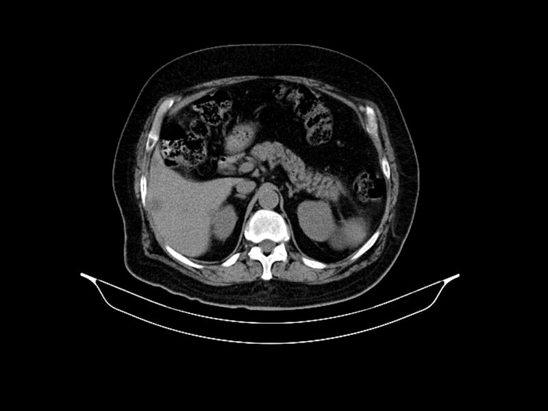 File:Adenocarcinoma of pancreas with hepatic metastasis (Radiopaedia 64332-73122 Axial non-contrast 34).jpg