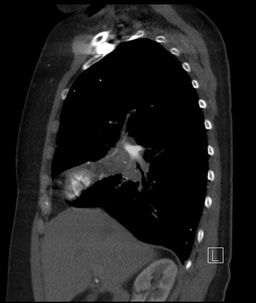 Adenocarcinoma of the lung (Radiopaedia 44205-47803 Sagittal C+ portal venous phase 37).jpg