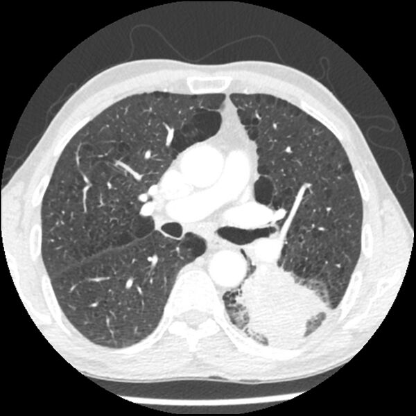 File:Adenocarcinoma of the lung - micropapillary predominant (Radiopaedia 42446-45563 C 35).jpg