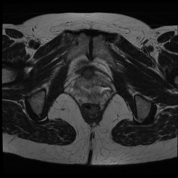 File:Adenoma malignum of the cervix (Radiopaedia 24460-24765 C 24).jpg