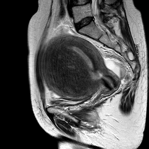 File:Adenomyoma of the uterus (huge) (Radiopaedia 9870-10438 Sagittal T2 7).jpg