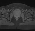 Adenomyosis - ovarian endometriomas (Radiopaedia 67031-76350 Axial T1 fat sat 23).jpg