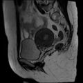 Adenomyosis and endometriotic cysts (Radiopaedia 82300-96367 Sagittal T2 8).jpg