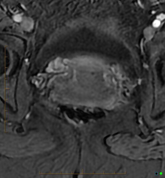 File:Adenomyosis uterus with hematometra (Radiopaedia 45779-50011 Axial T1 C+ fat sat 50).jpg