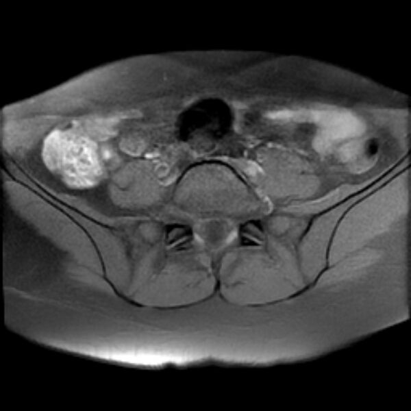 File:Adenomyosis within a septate uterus (Radiopaedia 69963-79981 Axial T1 fat sat 4).jpg