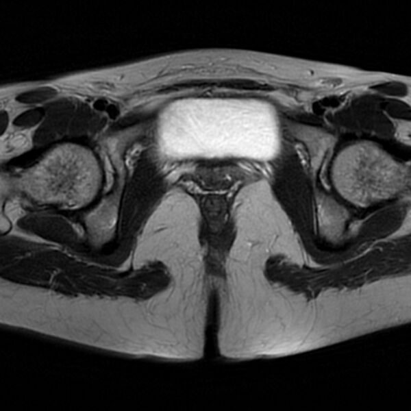 File:Adenomyosis within a septate uterus (Radiopaedia 69963-79981 Axial T2 27).jpg