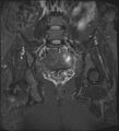 Adnexal multilocular cyst (O-RADS US 3- O-RADS MRI 3) (Radiopaedia 87426-103754 Coronal T2 fat sat 20).jpg