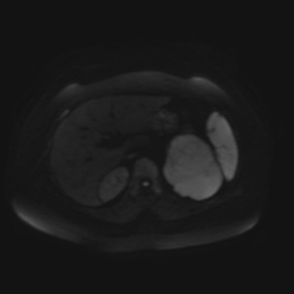 File:Adrenal cortical carcinoma (Radiopaedia 70906-81116 Axial DWI 38).jpg
