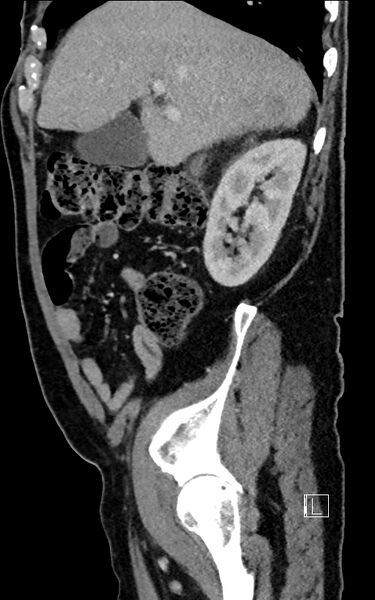 File:Adrenal lymphoma (Radiopaedia 73730-84529 Sagittal C+ portal venous phase 29).jpg