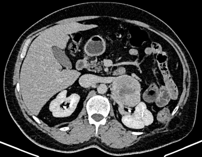 File:Adrenal metastases (Radiopaedia 73082-83791 Axial C+ delayed 119).jpg