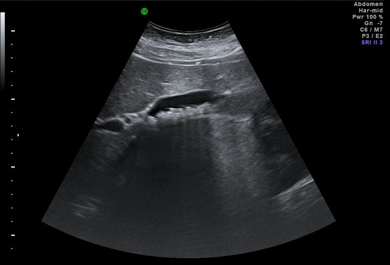 File:Adrenal myelolipoma - bilateral (Radiopaedia 74805-85811 Abdominal ultrasound 1).jpg