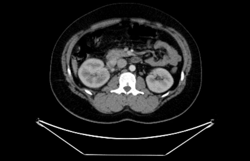 File:Adrenocortical carcinoma (Radiopaedia 80134-93438 Axial C+ portal venous phase 58).jpg