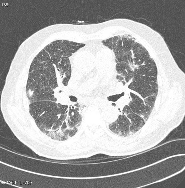 File:Amiodarone lung (Radiopaedia 6539-7851 Axial lung window 14).jpg