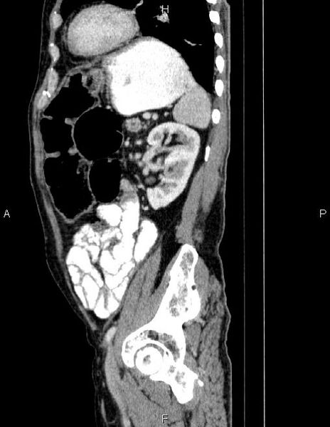 File:Ampullary adenocarcinoma (Radiopaedia 86093-102032 D 71).jpg