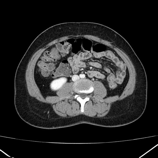 File:Ampullary tumor (Radiopaedia 22787-22816 C 37).jpg