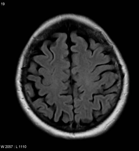 File:Amyotrophic lateral sclerosis (Radiopaedia 5373-7134 Axial FLAIR 19).jpg