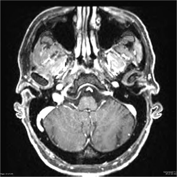 File:Anaplastic meningioma with recurrence (Radiopaedia 34452-35788 Axial T1 C+ 23).jpg