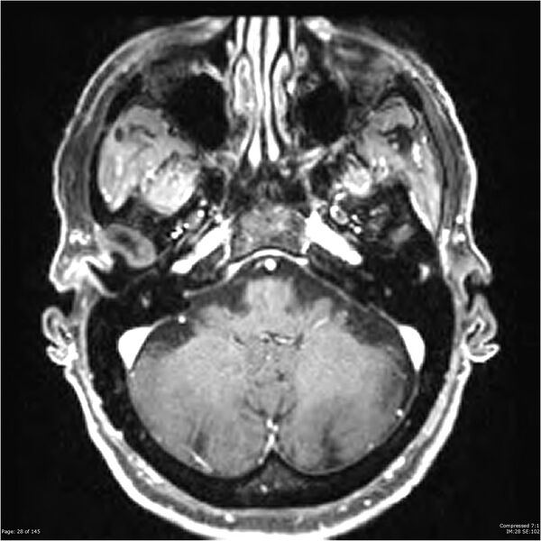 File:Anaplastic meningioma with recurrence (Radiopaedia 34452-35788 Axial T1 C+ 28).jpg