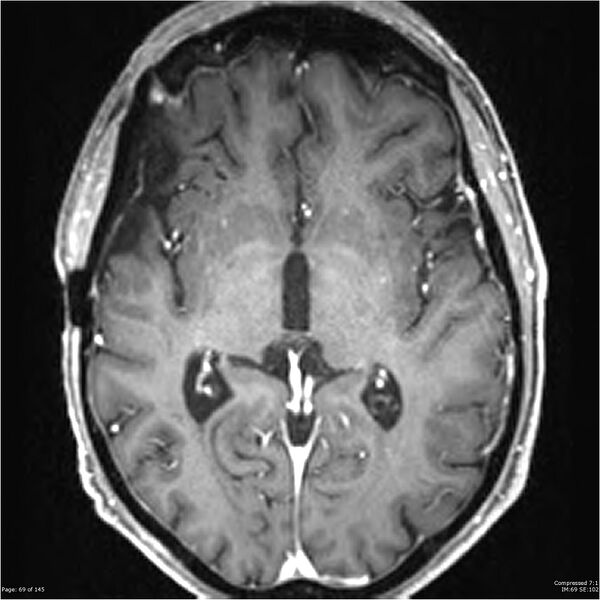 File:Anaplastic meningioma with recurrence (Radiopaedia 34452-35788 Axial T1 C+ 69).jpg