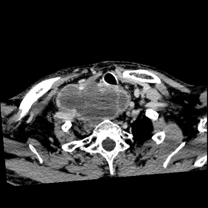 Anaplastic thyroid carcinoma (Radiopaedia 79087-92034 B 34).jpg