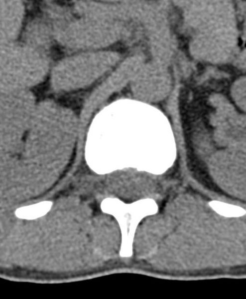 File:Aneurysmal bone cyst T11 (Radiopaedia 29294-29721 Axial non-contrast 57).jpg