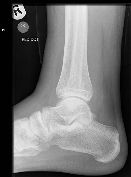 File:Ankle fracture - Weber B (Radiopaedia 8787-9588 Lateral 1).jpg