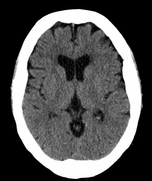 File:Anomalous intracranial venous drainage (Radiopaedia 28161-28418 Axial 21).png