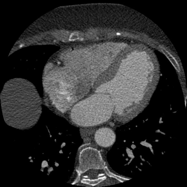 File:Anomalous origin of left circumflex artery from right coronary sinus (Radiopaedia 72563-83117 B 100).jpg