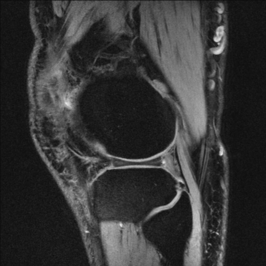 Anterior cruciate ligament mucoid degeneration (Radiopaedia 68400-77933 Sagittal 10).jpg