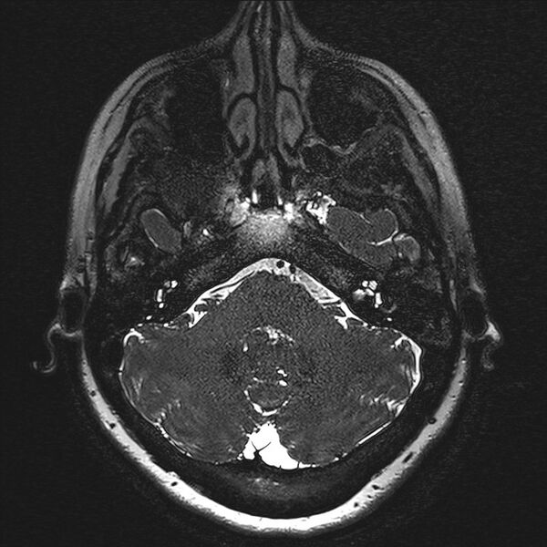 File:Anterior temporal encephalocele (Radiopaedia 82624-96808 Axial T2 high res 6).jpg