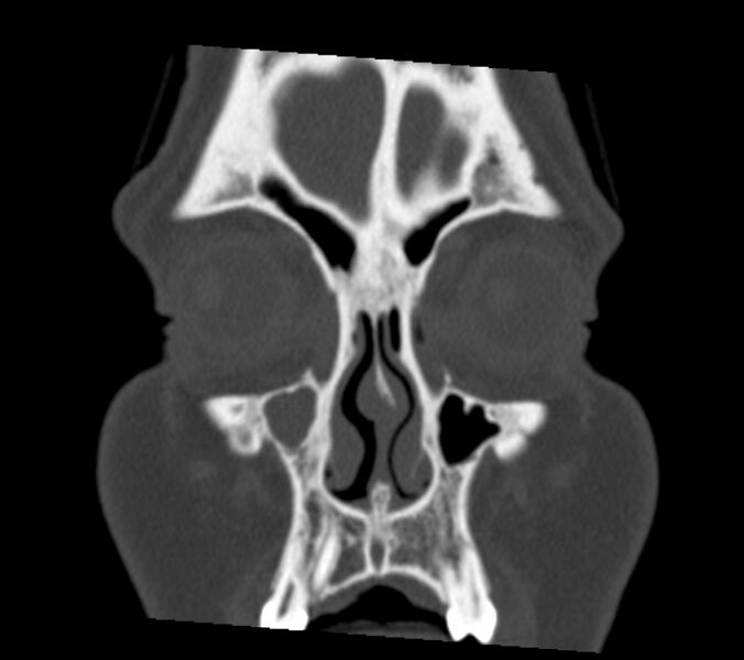 File:Antrochoanal polyp (Radiopaedia 21894-21868 Coronal bone window 5).jpg