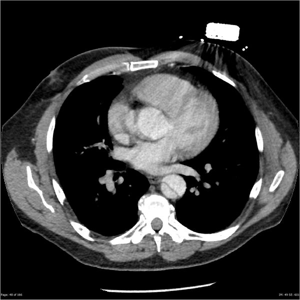 File:Aortic dissection- Stanford A (Radiopaedia 37759-39664 A 39).jpg