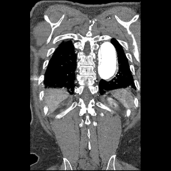 File:Aortic dissection - DeBakey Type I-Stanford A (Radiopaedia 79863-93115 B 33).jpg